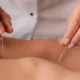 Acupuncture: Your Complete Guide to Stress and Anxiety Relief