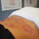 Sports Recovery Acupuncture: 6 Essential Benefits to Discover