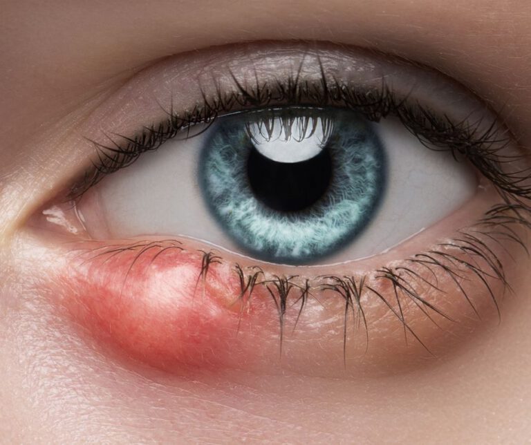 Home Remedies for Eye Styes: Causes and Solutions Explained