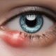 Home Remedies for Eye Styes: Causes and Solutions Explained